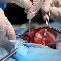heart surgery